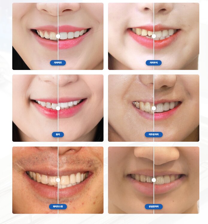 Before & After 종합